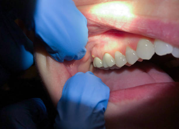 Best Emergency Dentist for Lost Fillings or Crowns in Mckeesport, PA